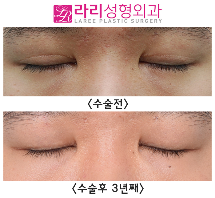 [Rari Plastic Surgery] Causes of Uneven Eye Size After Double Eyelid Removal Surgery, Cases That Naturally Even Out, Before-and-After Photos image 6