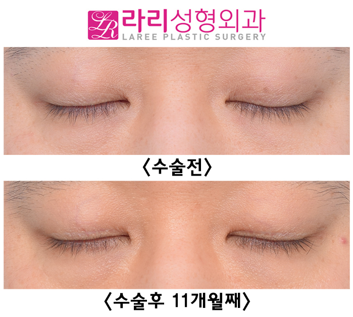 [Lari Plastic Surgery] Surgery Before-and-After Photos for Removing Multiple Eyelid Folds That Are Hard to Leave Alone image 5