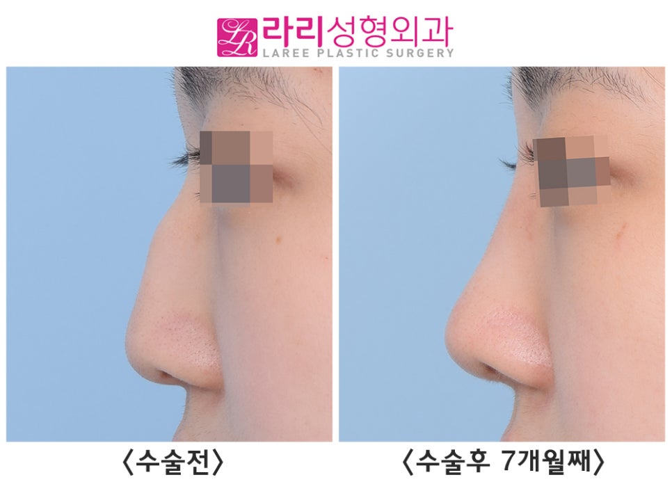 [라리성형외과] 선천성 매부리코, 첫코성형으로 고민하지 말고 매끄럽게 바꾸자 관련 이미지 4