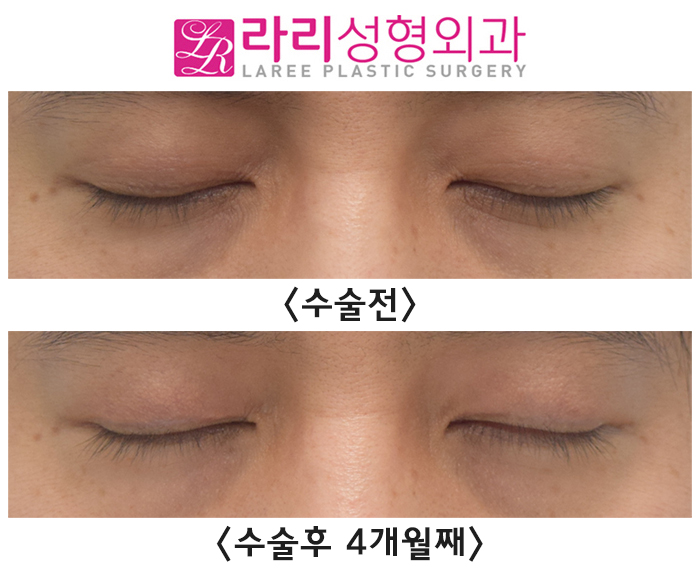 [라리성형외과] 자연쌍꺼풀 지워서 무쌍꺼풀 만드는 눈 수술 전후 사진 관련 이미지 3