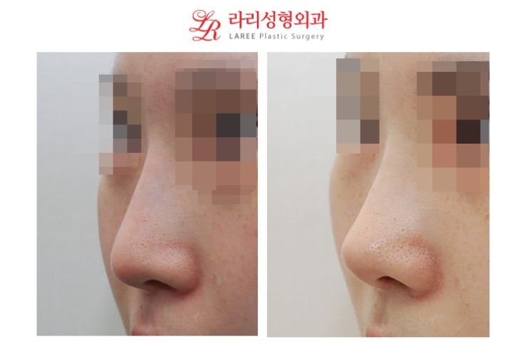 Revision Rhinoplasty for a Drooping Nose & Revision Surgery for a Drooping Nasal Tip
Long Nose & Long Nasal Tip Revision Surgery Before-and-After Photos image 1