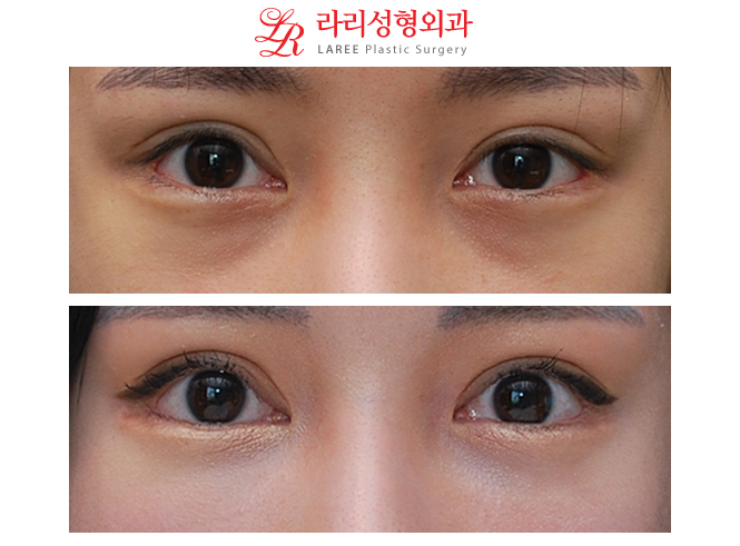 왼쪽 눈매교정재수술, 눈꼬리내리기뒤트임재수술, 눈밑지방제거 수술후 장기경과 전후사진☆ 관련 이미지 1