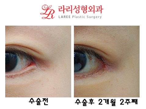쌍꺼풀재수술(쌍꺼풀낮추는수술),뒤트임재수술,트임없는앞트임 관련 이미지 4