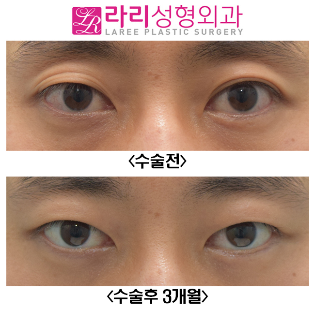 [라리성형외과] 쌍꺼풀없애기와 함께 한 윗눈꺼풀 패임 교정, 눈두덩이(Roof) 지방이식수술 전후사진 관련 이미지 2