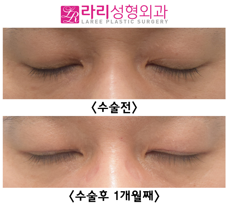 [라리성형외과] 쌍커풀 없애는 수술 후 회복이 빠른 경우 전후 사진 관련 이미지 3
