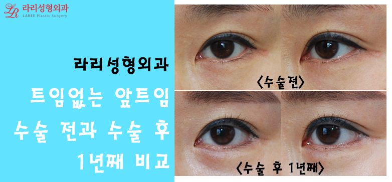 몽고주름, 더이상 헤매지말고 트임없는앞트임으로! 관련 이미지 8