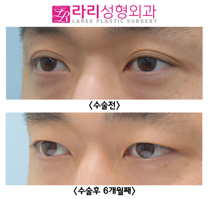 [라리성형외과] 두꺼운 자연 쌍꺼풀 완전 무쌍으로 만드는 쌍꺼풀제거수술 전후사진 관련 이미지 5