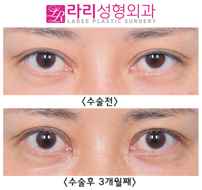 [Lari Plastic Surgery] Thick out-line double eyelids are best treated with double-eyelid revision surgery to lower the line, along with epicanthoplasty restoration!! image 1