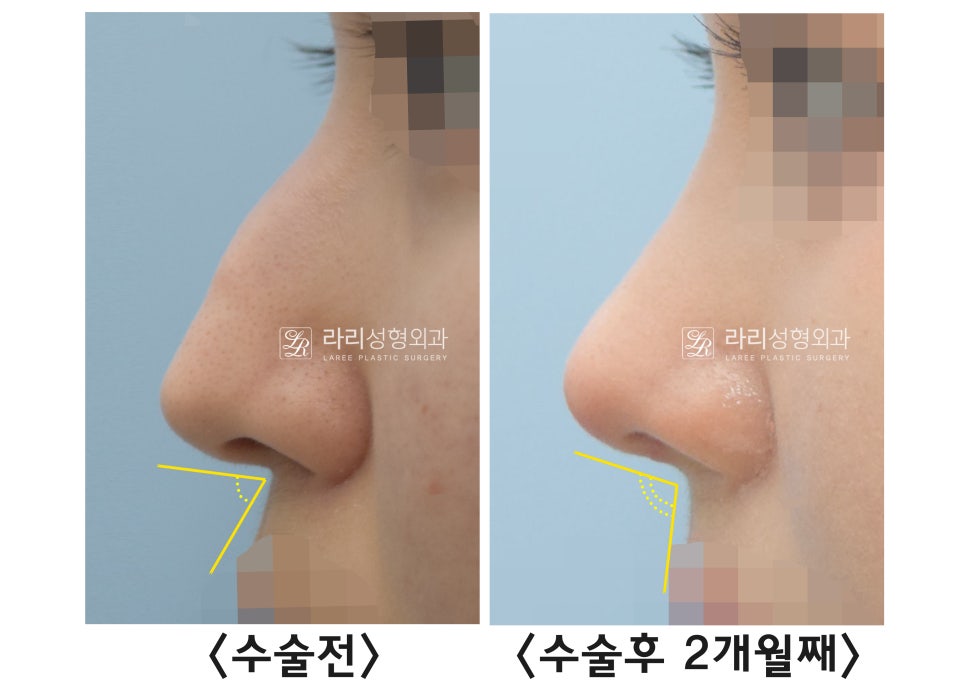 [라리성형외과] 절골을 포함한 매부리코 교정 수술(비순각 교정) 관련 이미지 7