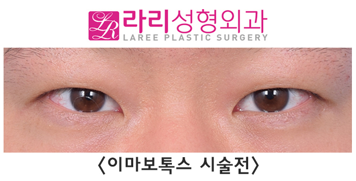 [라리성형외과] 이마미간 보톡스 그리고 절개 눈매교정 수술 전후 사진 단기 경과 관련 이미지 1