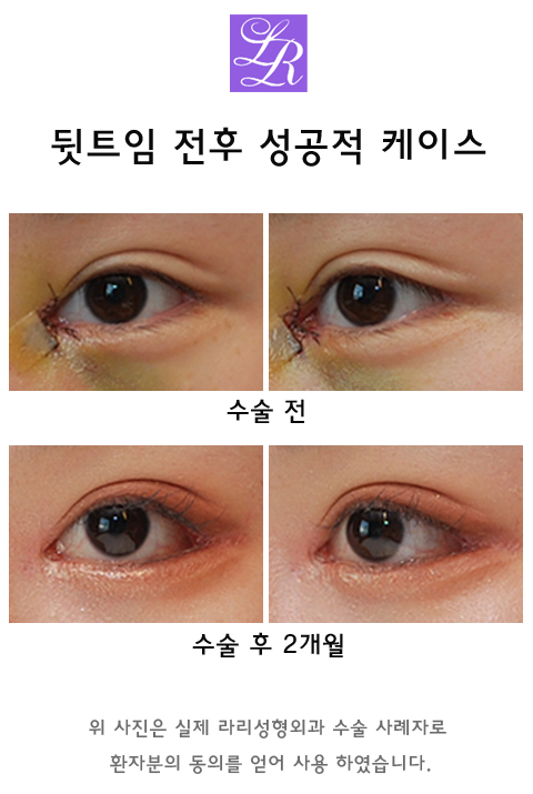 속눈썹 찌름 - 안검내반 교정 최소절개 흉터에 대해 관련 이미지 2