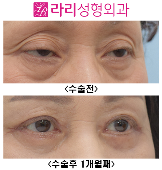 [Lari Plastic Surgery] Before and After Upper Blepharoplasty and Lower Blepharoplasty image 3
