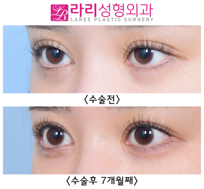 [라리성형외과] 한 번에 한 여러 가지 눈 수술 경과 (쌍꺼풀재수술, 앞트임복원, 뒤트임수술, 눈밑지방이식) 관련 이미지 3