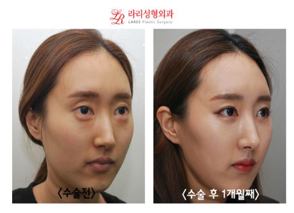 [Big-Eyed Canthoplasty] Revision Surgery for Lateral Canthoplasty to Lower the Outer Eye Corner / Revision Surgery for Lowering the Outer Eye Corner, Before-and-After Photos of Under-Eye Fat Repositioning image 2