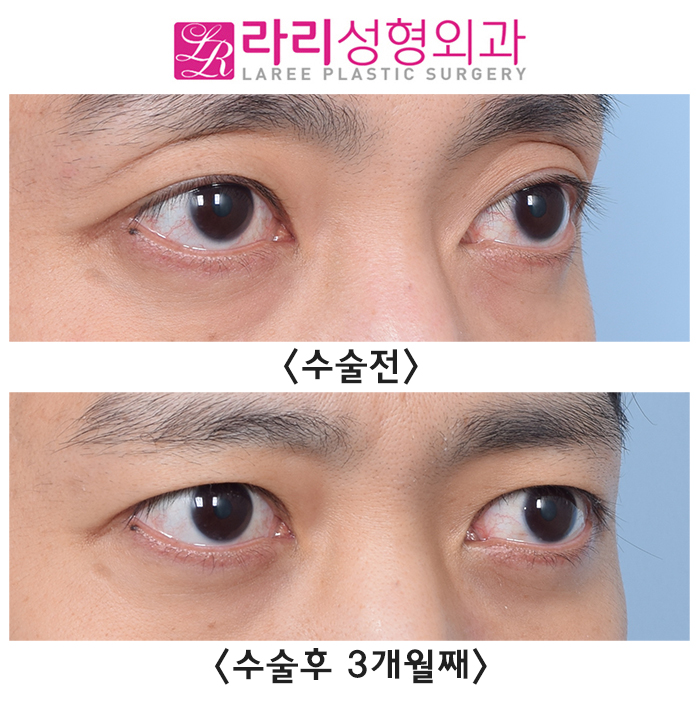 [Lari Plastic Surgery] Bulging Eyes? Sunken Eyes? Smoother with Fat Grafting and Double Eyelid Removal image 1