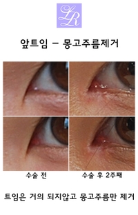 앞트임전후 - 몽고주름 두줄 갈고리 해결 (feat. 라리 트임없는앞트임) 관련 이미지 3