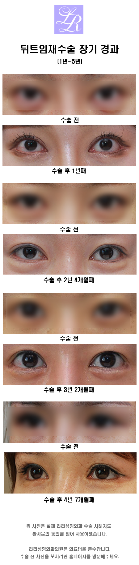 Why Revision Surgery Is Common for Outer Corner Eye Surgery image 8