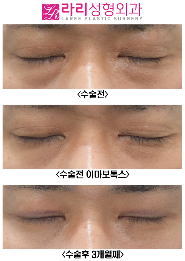 [라리성형외과] 여러겹 쌍꺼풀 제거 관련 이미지 5
