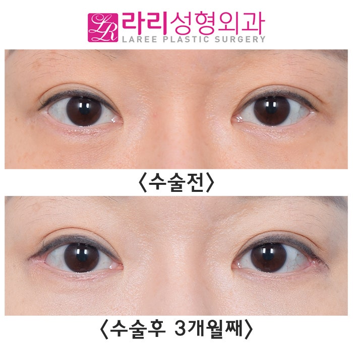 [라리성형외과] 뒤트임재수술 티 나게 잘하는 병원 라리성형외과 관련 이미지 1