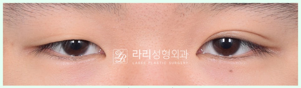 [Lari Plastic Surgery] Removing a Visible Double Eyelid (Double Eyelid Reversal Surgery), From Natural Double Eyelids to Surgical Double Eyelids: A to Z image 3