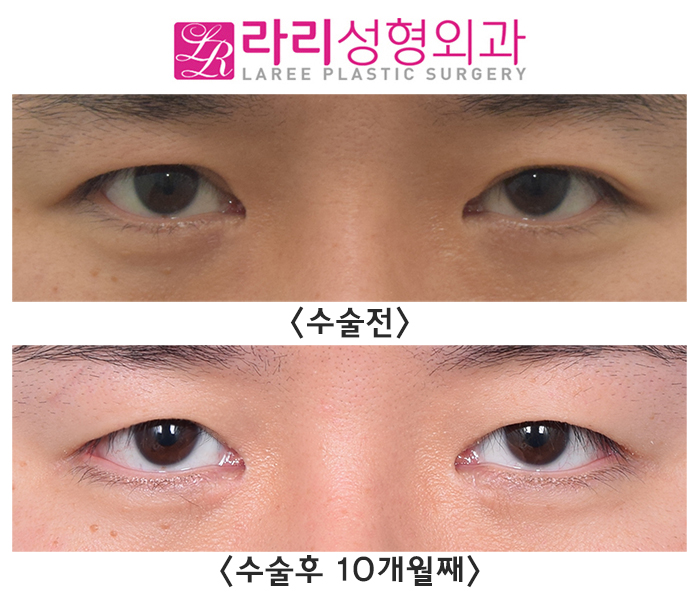 [라리성형외과] 눈이 조금 작아져도 괜찮다면 완전 무쌍으로 쌍꺼풀없애기 수술을 받아요. 쌍꺼풀없애기, 앞트임재수술, 뒤트임 수술 후 10개월째 관련 이미지 1