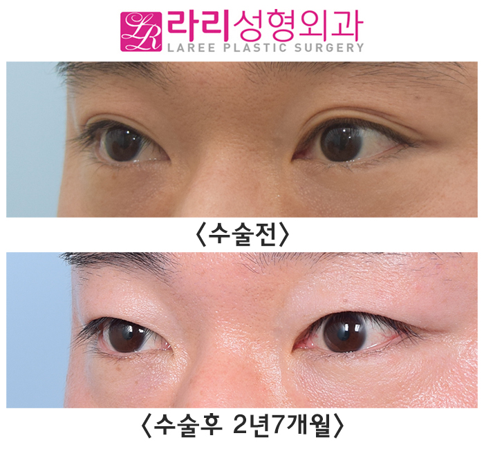 [라리성형외과] 자연쌍꺼풀없애기 2년 이상 장기 경과 전후 사진 관련 이미지 1