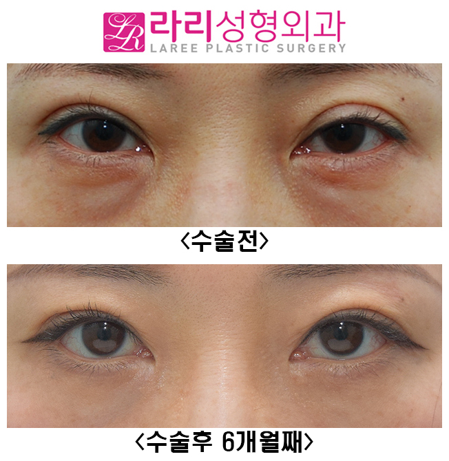[라리성형외과] 쌍꺼풀재수술, 앞트임재수술, 눈밑지방재배치재수술 전후사진 관련 이미지 1
