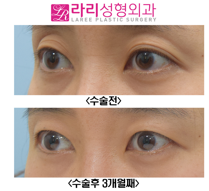 [라리성형외과] 윗눈꺼풀 주름 같은 애매한 쌍꺼풀 무쌍 만드는 수술 관련 이미지 3