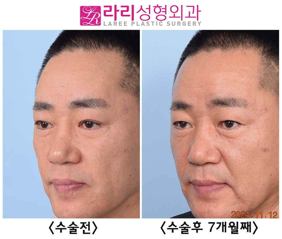 [Rari Plastic Surgery] Comparing Before and After Photos of Double Eyelid Removal Surgery (Double Eyelid Disappearance + Mucosal Ptosis Correction) image 4