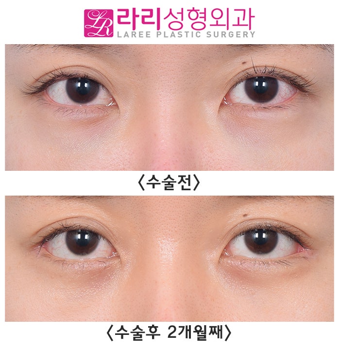 [라리성형외과] 다각도에서 바라보는 비대칭 뒤트임수술 관련 이미지 3