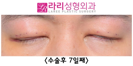 [라리성형외과] 쌍꺼풀없애기 수술 눈안감김(토안)의 원인이 정말 피부절제 때문일까? - 무절제쌍꺼풀없애기 관련 이미지 13