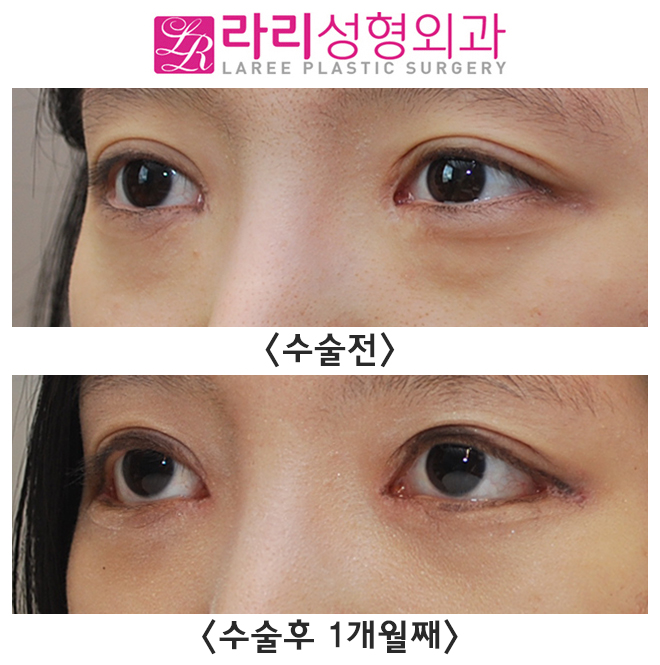 [라리성형외과] 앞트임재수술, 뒤트임재수술, 눈밑지방재배치 수술 한달경과 전후사진 관련 이미지 3