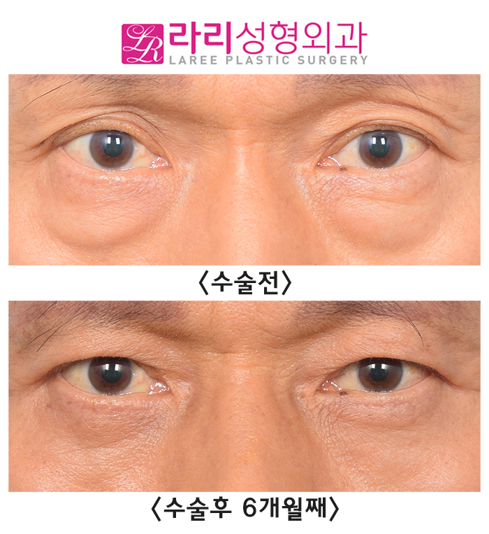 [Lari Plastic Surgery] Correction Surgery Before and After for Old Double Eyelid Surgery Side Effects, Sagging Skin, and Multiple Folded Double Eyelids image 1