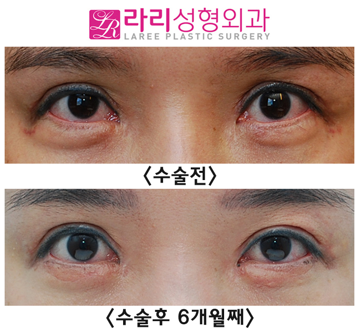 [Rari Plastic Surgery] Eyelid Ectropion Correction Surgery Methods According to Eye Condition image 4