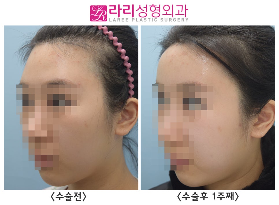 [Rari Plastic Surgery] Facial Fat Grafting (Forehead, Cheeks) Before-and-After Photos: 1-Week Progress image 2