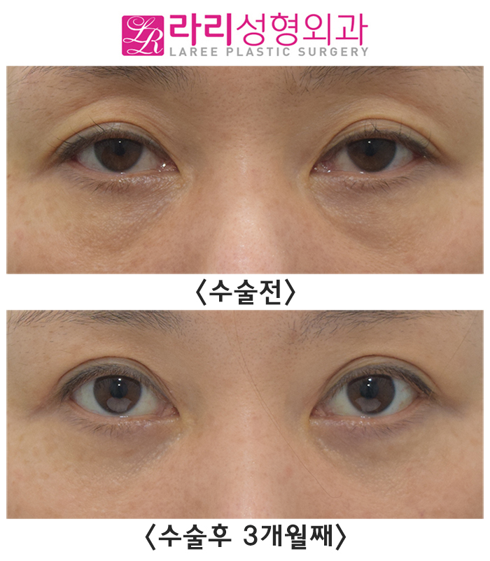 [라리성형외과] 절개눈매교정으로 윗눈꺼풀패임 개선될까?! (+ 눈밑지방재배치수술 ) 관련 이미지 2