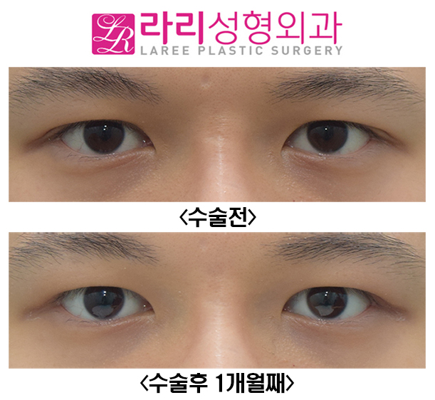 [Lari Plastic Surgery] Before and After of Double Eyelid Reversal Surgery, Which Can Also Remove a Hidden Double Eyelid image 1