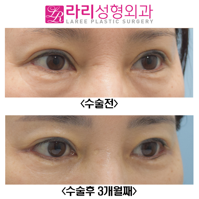 [Lari Plastic Surgery] Before-and-After Photos of Correcting Sausage-like Double Eyelids with Revision Double Eyelid Surgery image 2
