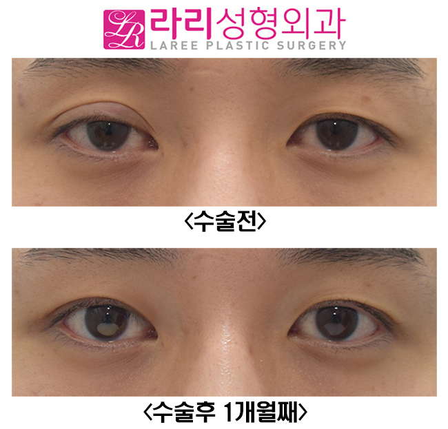[라리성형외과] 짝눈교정 한쪽눈 재수술 , 한쪽 쌍수 수술후 한달째 관련 이미지 1
