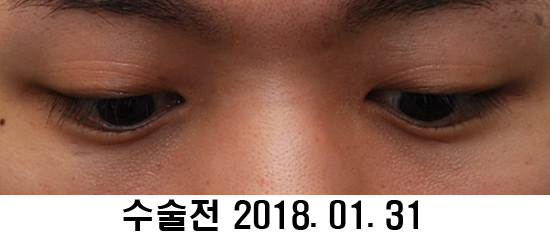 Before and After: Sharper Male Eye Correction (feat. Video) image 2