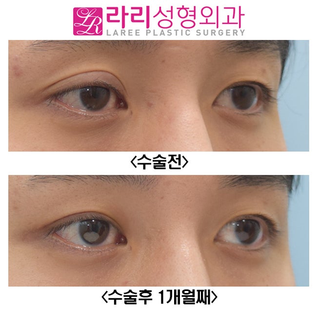 [라리성형외과] 짝눈교정 한쪽눈 재수술 , 한쪽 쌍수 수술후 한달째 관련 이미지 3