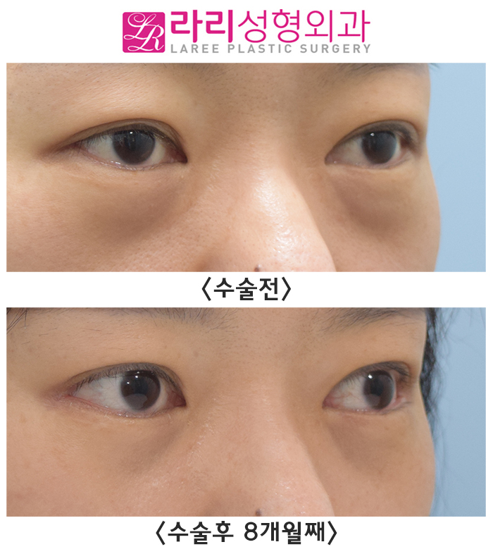 [라리성형외과] 뒤트임수술과 눈밑지방재배치 함께 하면 좋은 수술 best 관련 이미지 1