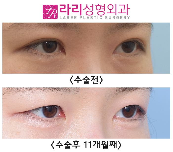 [라리성형외과] 지겨운 소세지 쌍꺼풀 싫어요, 자연스러운 속쌍 쌍꺼풀재수술 관련 이미지 4