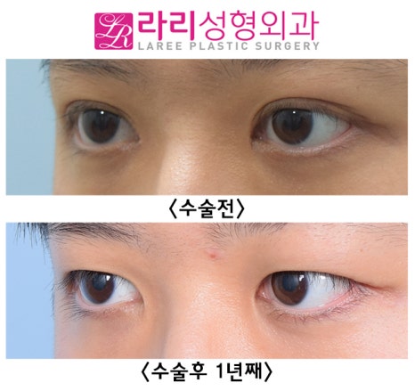 [라리성형외과] 재발률이 낮은 반영구 수술 쌍꺼풀없애기 관련 이미지 4
