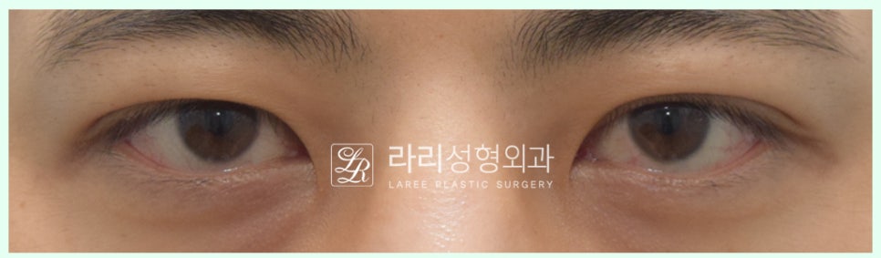 [Lari Plastic Surgery] Removing a Visible Double Eyelid (Double Eyelid Reversal Surgery), From Natural Double Eyelids to Surgical Double Eyelids: A to Z image 1
