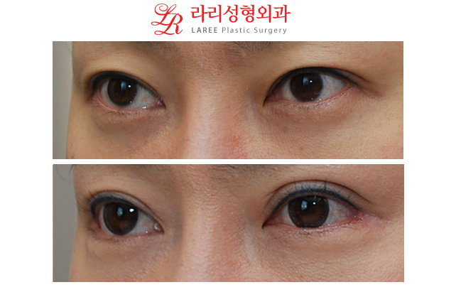 쌍꺼풀재수술 눈꼬리내리기뒤트임/눈꼬리내리기뒷트임 전후사진-※ 관련 이미지 1