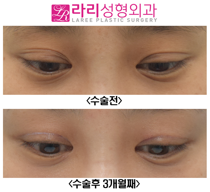 [라리성형외과] 쌍꺼풀 짝짝이, 쌍꺼풀 비대칭 교정 수술 전후 관련 이미지 3
