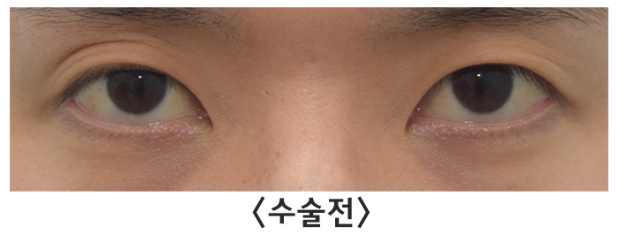 [라리성형외과] 여러 가지 쌍꺼풀 생기는 눈 무쌍으로 바꿔드립니다. 관련 이미지 3