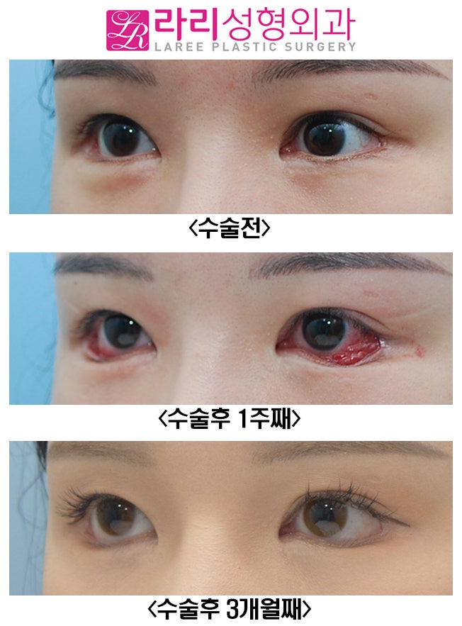 [Lari Plastic Surgery] Revision Lower Blepharoplasty: From Pre- and Post-Op Photos to the Recovery Course with Swelling image 3