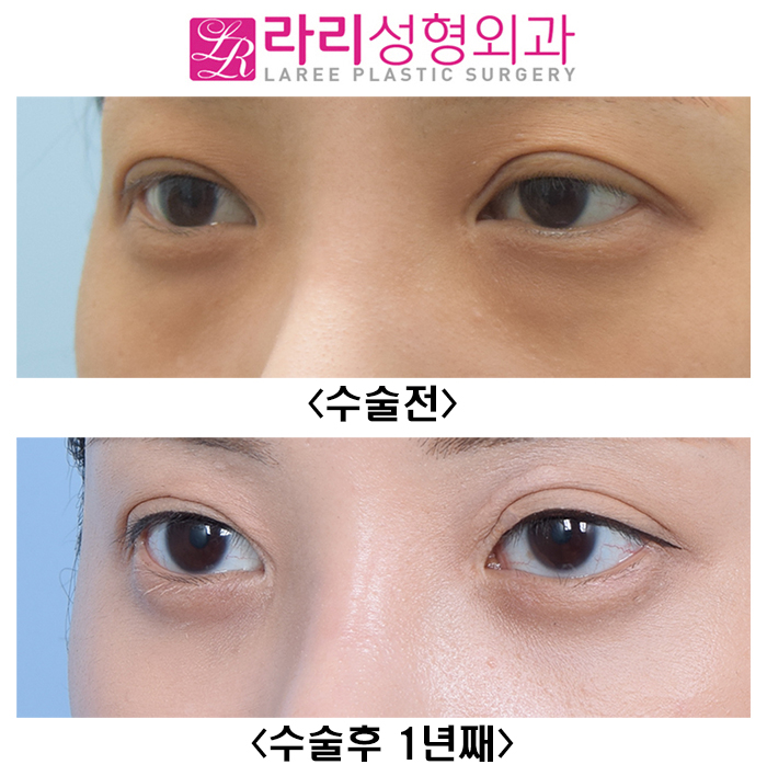 [Lari Plastic Surgery] Not a Lower Eyelid Fat Repositioning Surgery That Quickly Comes Back, but a Long-Lasting One image 4